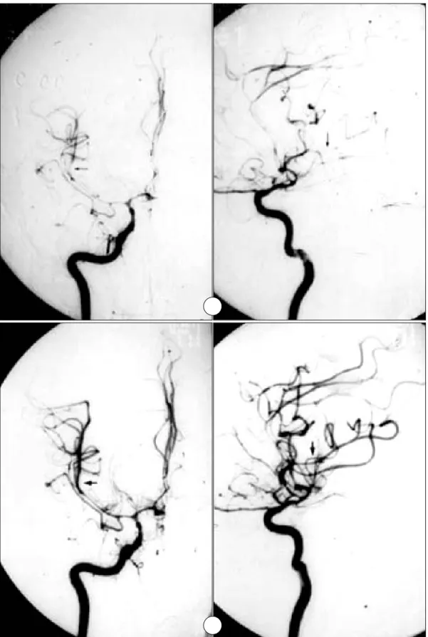 Fig. 1. A：38-year-old man presented with acute deterioration of the level of consciousness 7 days after rupture of anterior  communicating artery aneurysm