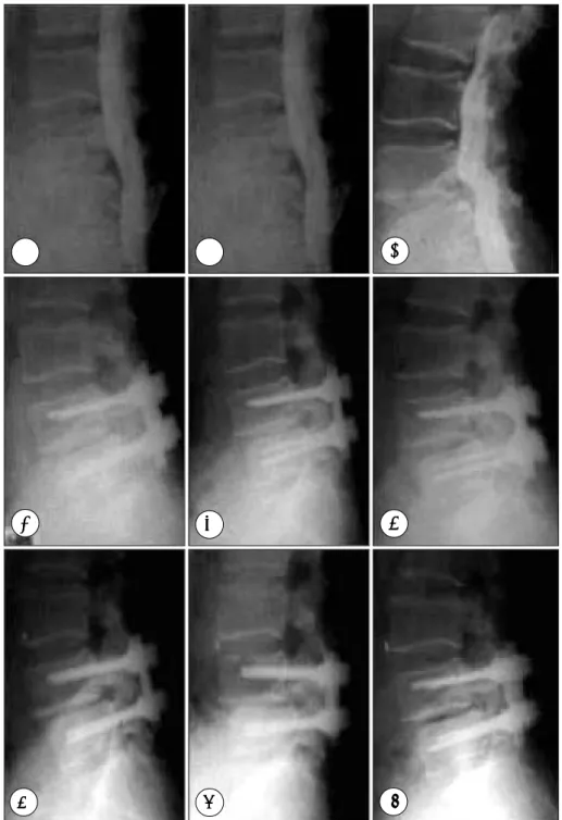 Fig. 6. Pictures of lumbar spine with pedicle screw fixation in neutral(A, D, G), flexion(B, E, H), and extension(C, F, I) positions sho- sho-wing preoperative L4-5 instability(A, B, C), early postoperative(D, E, F), and late postoperative dynamic views(G,