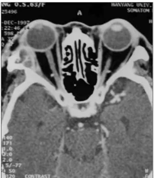 Fig. 1. Preoperative postcontrast axial CT scan showing an en- en-hanced mass that destroyed the lateral orbital wall on the right side