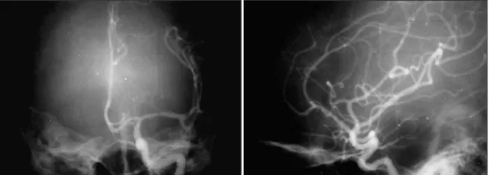 Fig. 2. Antero-posterior(Left) and Lateral(right) view of preoperative left carotid angiogram demonstrating displacement of  vascular structure without abnormal staining