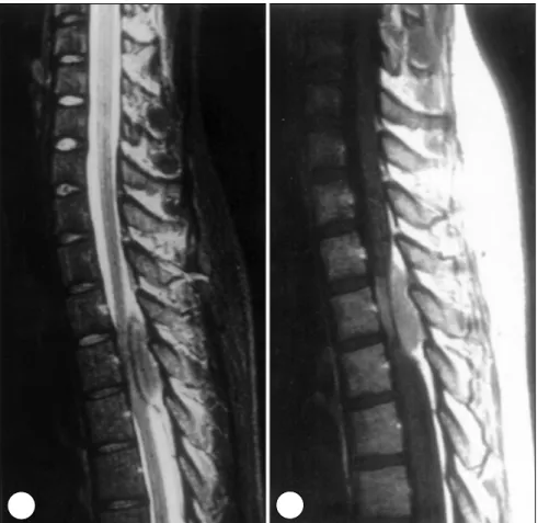 Fig. 1. Preopertive thoracic spinal MRI. A：T2 weighted sagittal image showing iso-signal extradural tumor mass compressing the  spinal cord at T4 level