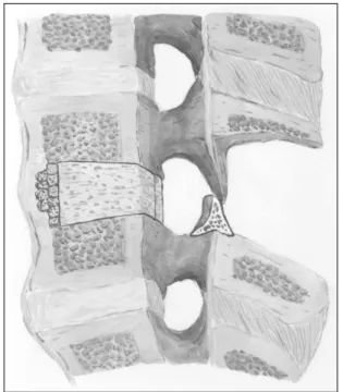 Fig. 3. The fusion method of graft bone. The anterior half of inter- inter-vertebral space is impacted with small bone chips