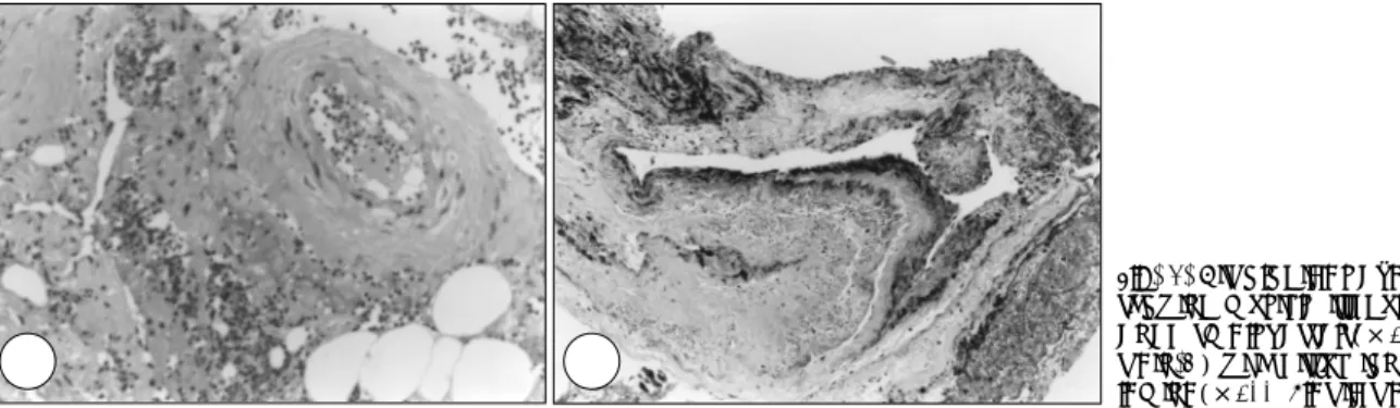 Fig. 4. Histological examination  showing multiple irregularly  thick-ened small vessels(×200, H &amp; E  stain-A) with disruption of elastic  lamina(×200, Elastic stain-B)