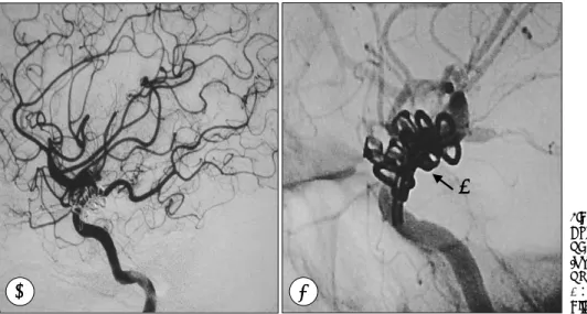 Fig. 5. A：Postoperative cerebral  angiography revealed intact  blo-od flow of the left ACA and MAC