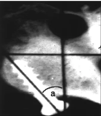 Fig. 3. An axial radiograph indicating how the axial deviation angle (a) is measured. 