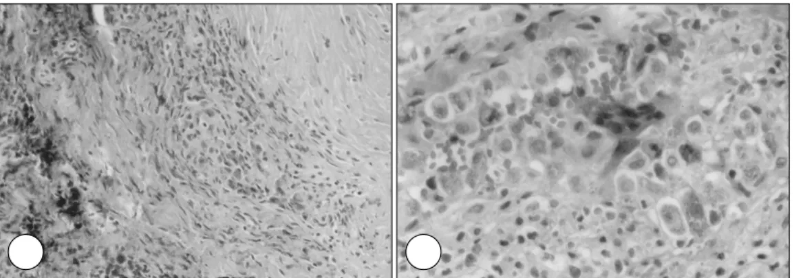 Fig. 3. Microscopic photograph of a surgical specimen. A：Note the synovial villi, distended by the proliferating tumor-like tissue,  and the sharp demarcation between this tissue and the underlying deep synovial connective tissue