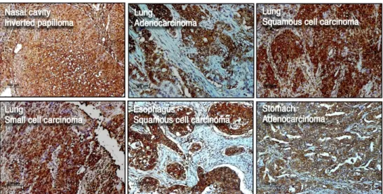 Fig. 2. Immunohistochemical detection of HIF-1α in various human tumors. Original magnification ×200