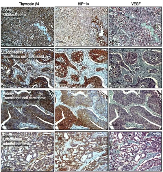 Fig. 4. Immunohistochemical detection of co-localized thymosin β4, HIF-1α and VEGF in various human tumors