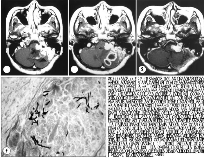 Fig. 1.  (case 1)  A：A 37 year-old woman underwent subo- subo-ccipital craniectomy and partial removal of cerebellopontine  angle schwannoma 16 months before admission