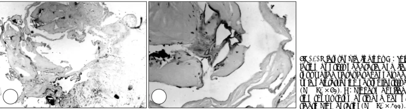Fig. 2. Microscopic findings A：This lesion consists of ectatic and  fib-rous walled vascular channels  de-void of intervening neuroglial tissue (H &amp; E, ×40)