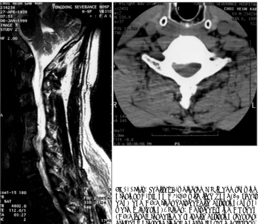 Fig. 1. Left：Sagittal T2-weighted MR image showing  previous C-AIF on C4-5-6 with iliac bone(12 years  ago) and C6/7 right cervical disc  extrusion(down-ward migration)