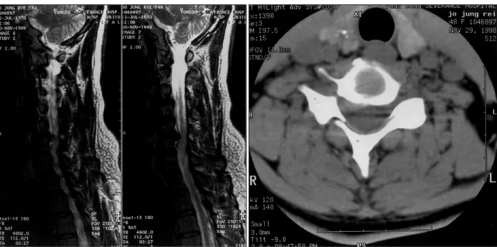 Fig. 2. Left：Sagittal T2-weighted MR image showing C5/6 right cervical disc extrusion