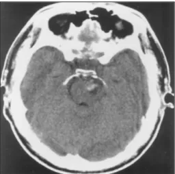 Fig. 1. Pre-operative brain CT showing hemorrhage in the inter- inter-peduncular cistern