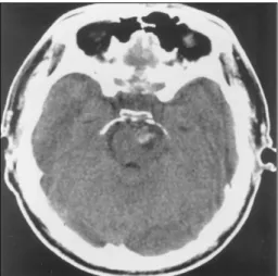 Fig. 1. Pre-operative brain CT showing hemorrhage in the inter- inter-peduncular cistern