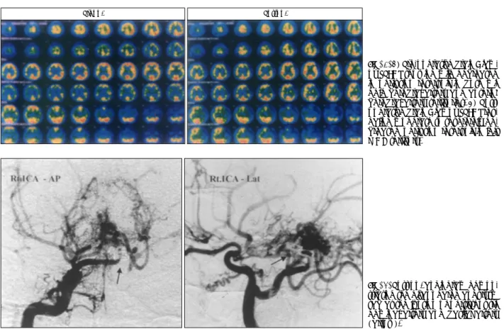 Fig. 3. 1) Pre-operative brain Diam- Diam-ox SPECT showing mild decreased  in perfusion reservoir in both  mi-ddle cerebral artery and anterior  cerebral artery territories