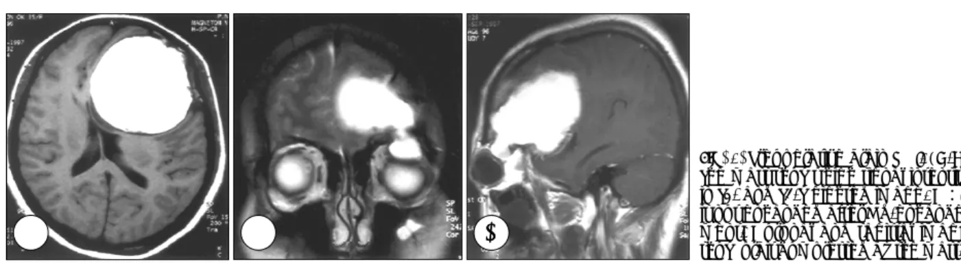 Fig. 1. Plain radiograph shows osteolytic lesion(arrow) in left supraorbital ridge extending to the fronto-zygomatic suture