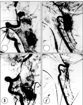 Fig. 1. A：brain CT at admission. B：CT after 4th IVH.   
