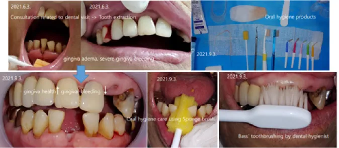 Fig. 3. A case of oral care for a 90-year-old woman who has difficulty in communicating due to hearing loss