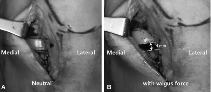 Fig. 3. Intraoperative photo demonstrating the instabilty with valgus force applied at full extension position