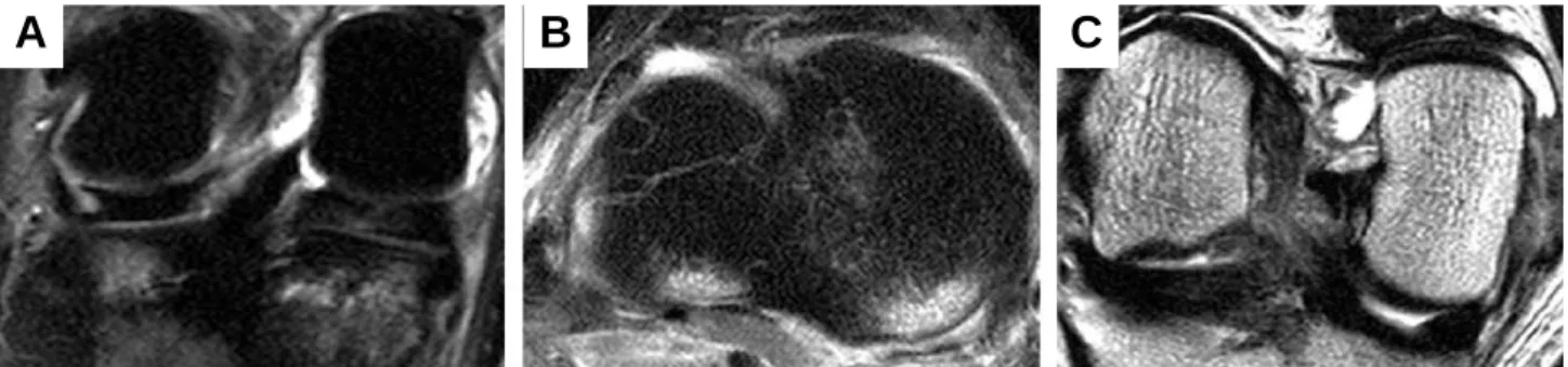 Table 4. Location of Bone Bruise according to the Mechanism of Injuries 