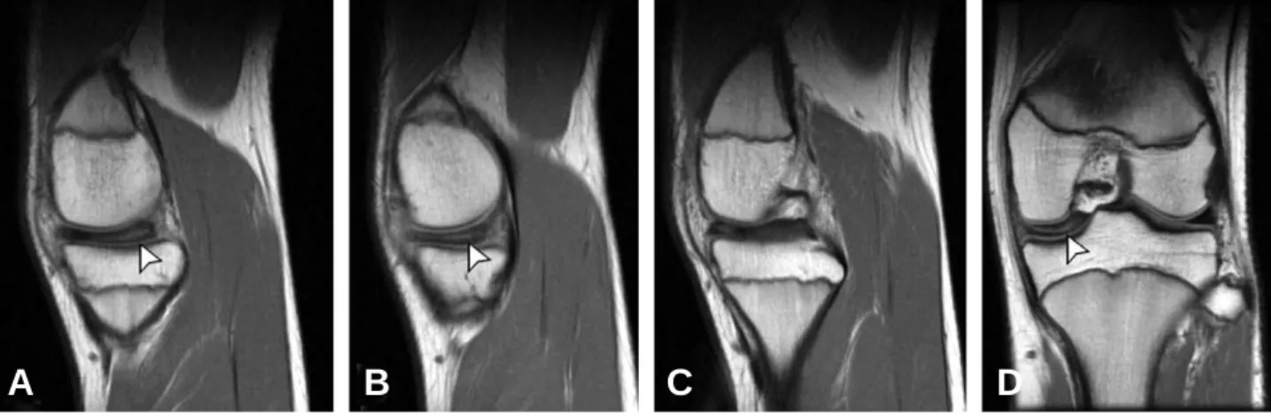 Fig. 2. Arthroscopy of the left knee. (A) Complete type medial discoid meniscus, obscuring the underlying tibial plateau completely.