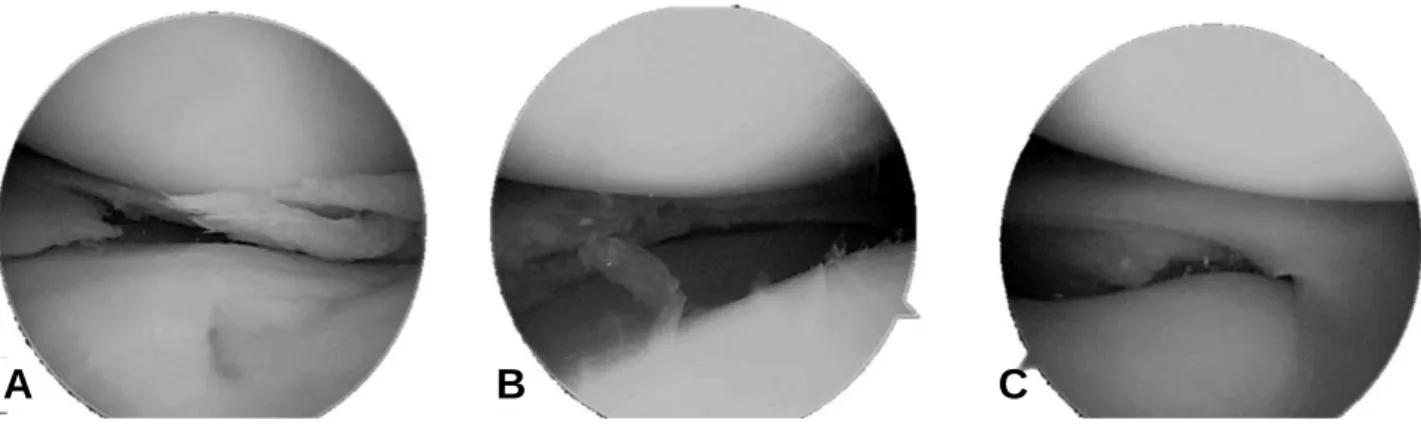 Table 1. Twenty-one Cases of Bilateral Discoid Medial Menisci which were Detected before 2010
