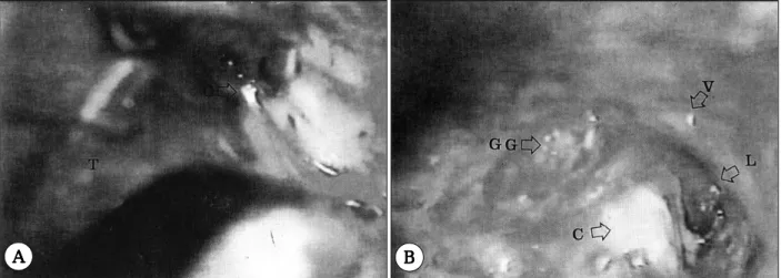 Fig. 3. Intraoperative pictures A：Before the facial nerve decompression. G：greater superficial petrosal nerve(GSPN), T： tem- tem-poral lobe, R：retractor B：After the facial nerve decompression