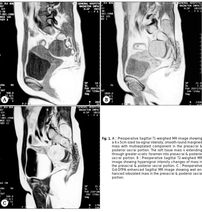 Fig. 1. A：Preoperative Sagittal T1-weighed MR image showing  a 6×5cm sized Iso-signal intensity, smooth-round margined  mass with multiseptated component in the presacral &amp; 