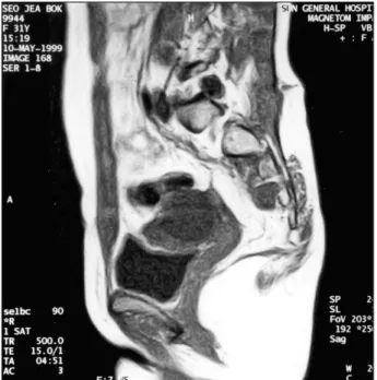 Fig. 2. Postoperative Sagittal T1-weighed MR image showing removal of previous mass on the presacral &amp; posterior sacral portion