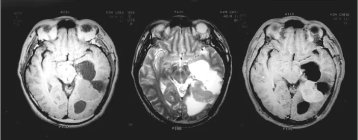 Fig. 3. On MRI taken 11 months after surgey, a recurrent mass is noted in the previously operation site