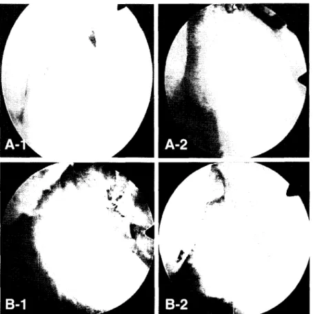 Fig. 8. 2nd look arthroscopic findings of the grafts with (A) conventional technique, it shows taut graft with visible fiber bundle 돊  in  thin synovium, and (B) remnant preserving  也: hnique, it  마 sws taut graft with invisible fiber bundle due to thick s