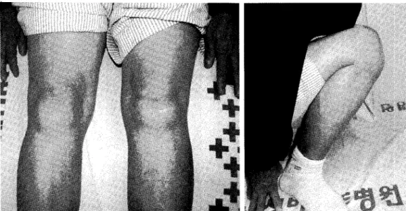 Fig. 5.  After three years,  the  patient showed  full range  of motion of  the  knee with  mild laxity.