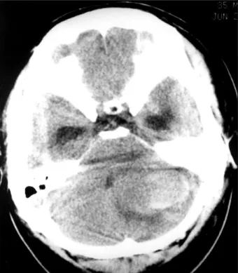 Fig. 3. A computed tomography scan of the brain obtained on the tenth admission day showing a large hematoma and peripheral edema in the left cerebellar hemisphere with enlarged temporal horns of both lateral ventricles and deviation of the fourth ventricl
