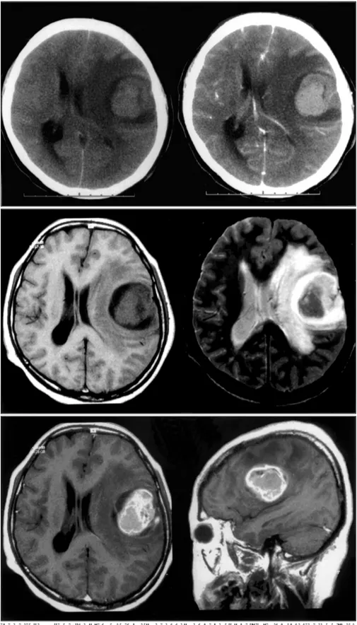 Fig. 2. Brain CT : Precontrast CT scan showing a large tumor of homogeneous density in the left frontoparietal area