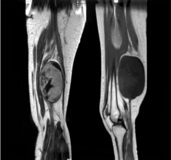Fig. 3. Left thigh MRI(coronal and sagittal images) showing a huge mass related to the sciatic nerve