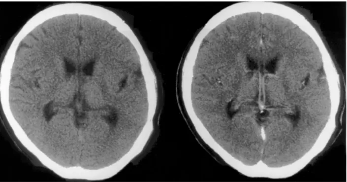 Fig. 5. Follow-up CT(pre- &amp; postcontrast) taken after one year after operation showing no recurrence of the tumor