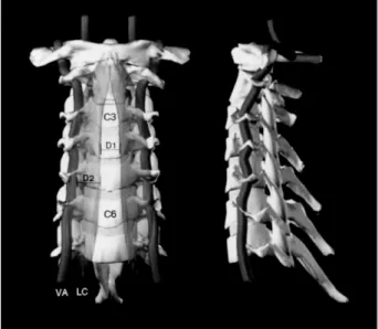 Fig. 7. Drawings using computer graphics showing the ana- ana-tomic relationship between the body of cervical spine and vertebral artery
