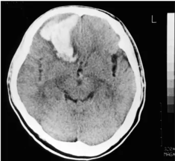 Fig. 1. The initial CT scan showing on intracerebral hematoma with slight mass effect in the right frontobasal region