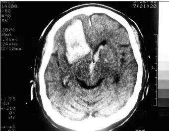 Fig. 5. Computed tomographic scan shows a intracerebral hematoma with ventricular rupture and compression of the anterior horn of lateral ventricle