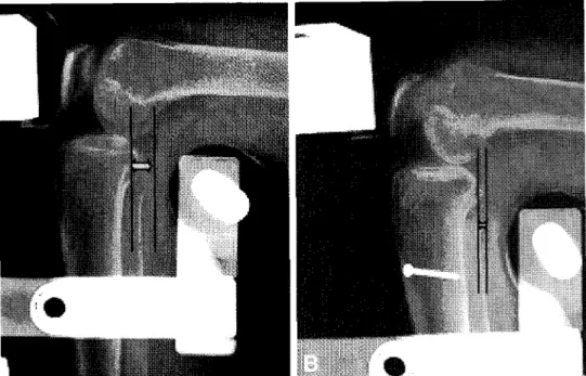 Fig. 1. Preoperative &amp; Follow-Up 90 flexion Telos view. (A) Preoperative 90 flexion Telos stress view show 7 mm tibial ant