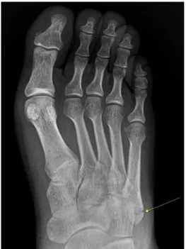 Fig.  1.  X-ray  of  left  foot  (December  4,  2019). Fig.  2. X-ray  of  left  foot  (December  11,  2019).