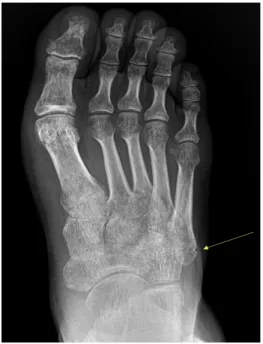 Fig.  3.  X-ray  of  left  foot  (December  30,  2019).