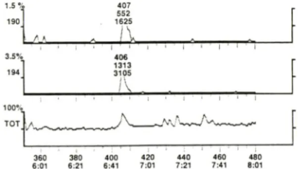 Fig. 1 —Mass  chromatograms  for  m/e  190(ampheta-  mine-PFP),  194(amphetamine-dr,-PFP)and  total  ion  chromatogram  from  a  methamphetamine  user^s  hair  sample.