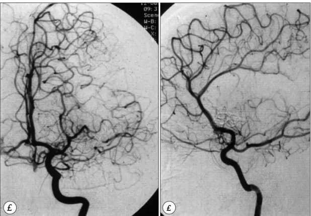 Fig. 4. Postoperative angiogram(A：anteroposterior view, B：lateral view) showing no visualization of left middle cerebral artery