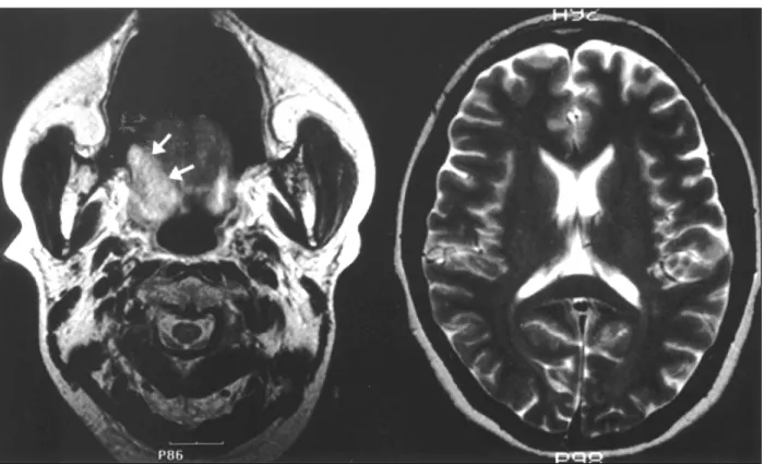 Fig. 1. Left：Face MRI showing enhanced, localized mass in right posterolateral aspect of tongue base