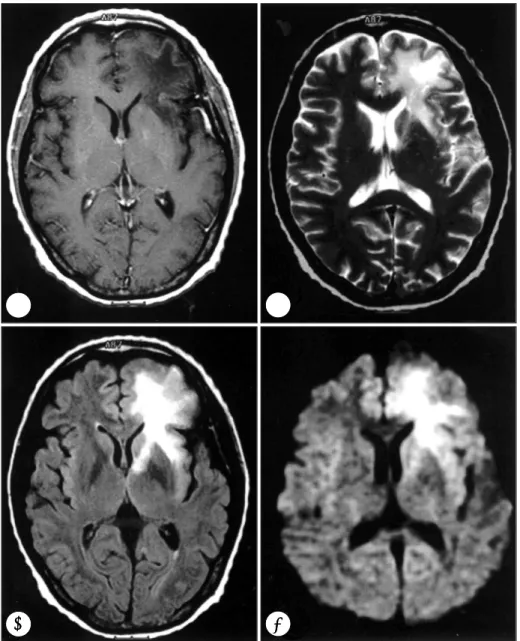 Fig. 2. Follow-up brain MRI(8 days before brain biopsy) showing non-enhanced, hypointense, diffuse lesion involving white matter of  left frontal lobe, insula, and anterior limb and genu of internal capsule in T1WI (A)