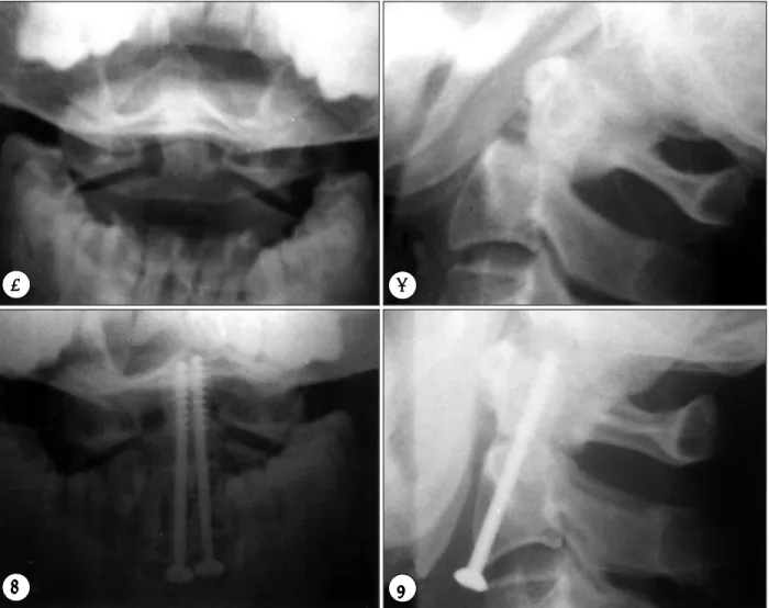 Fig. 2. A and B：Preoperative anteroposterior and lateral cervical X-ray showing type  Ⅱ-P odontoid fracture