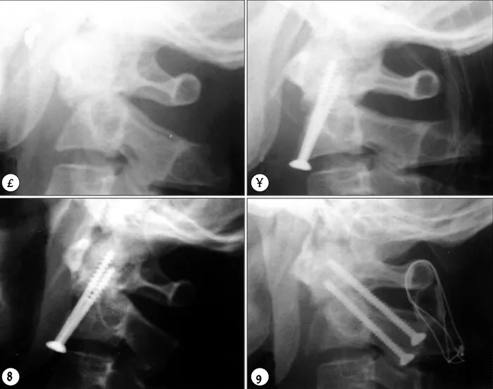 Fig. 3. A：Preoperative lateral cervical X-ray showing type  Ⅱ-A odontoid fracture in which fracture line is oblique downward  and forward