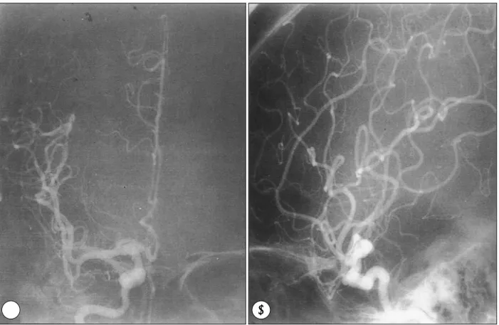 Fig. 3. Preoperative right carotid angiograms(A：frontal, B：lateral projection). A saccular aneurysm arising from the medial wall of  the communicating segment of the internal carotid artery