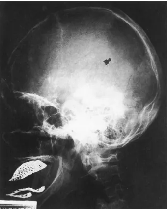 Fig. 2. Brain CT scan in Case 1. In the noncontrast scan, a homogenous well marginated ovoid mass lesion is seen, causing a  right parietal bone defect